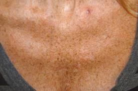 Common Signs of Aging for the Neck and Chest | Audubon Dermatology