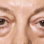 Dark Circles, Bags, and Other Signs of Aging Eyes | Audubon Dermatology